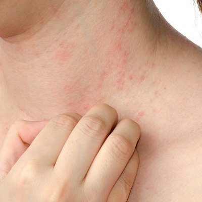 Seborrheic Dermatitis Raleigh Nc